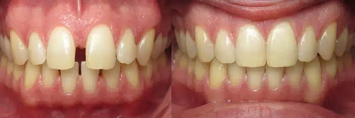 gap tooth treatment invisalign